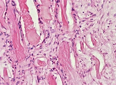 Desmoid tumor: benign but nasty | Pathology Student