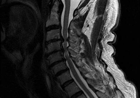 Cervical myelopathy: Discoveries paving the way to better care - Mayo ...