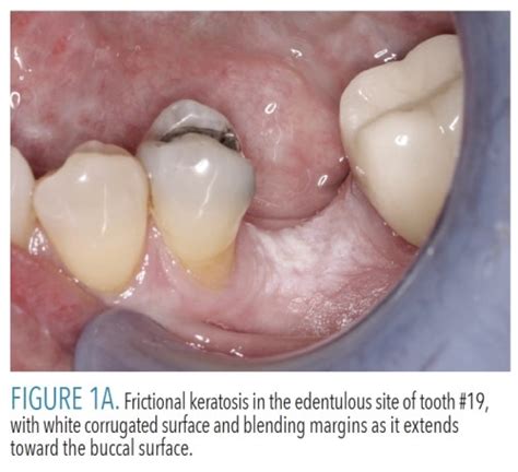 White Lesions Oral Mucosa