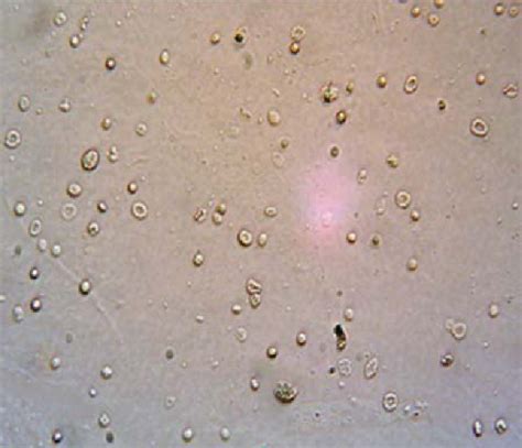 Examination of urinary sediment shows typical dysmorphic hematuria with ...