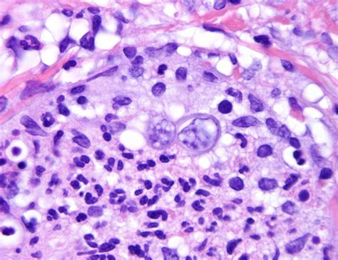 Blastomycosis | Dermatopathology