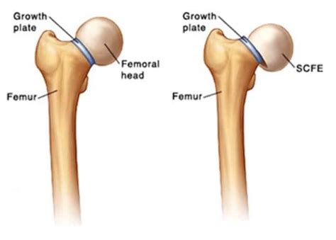 SLIPPED CAPITAL FEMORAL EPIPHYSIS (SCFE) - New