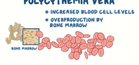 What is Polycythemia vera? - MEDICINE FOR WORLD