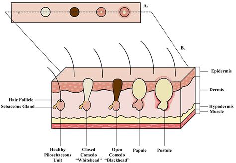 What Is Acne and What Causes It? · Frontiers for Young Minds