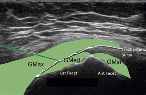 Trochanteric Bursa Injection: Ultrasound- Sports Medicine Review