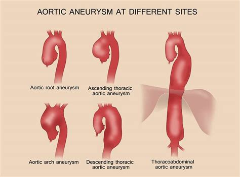 Aortic Aneurysm