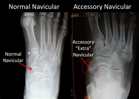 Accessory Navicular Bone - FootEducation