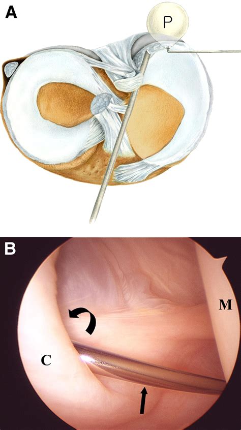 Arthroscopic Treatment of Popliteal Cysts: Clinical and Magnetic ...