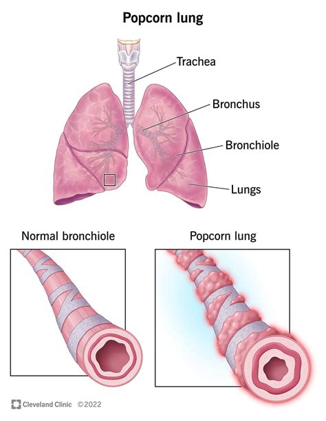 Popcorn Lung: Causes, Symptoms, Treatment & Is It Real