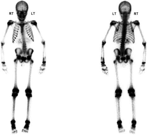 Triple-phase bone scan revealing moderately increased radiotracer ...