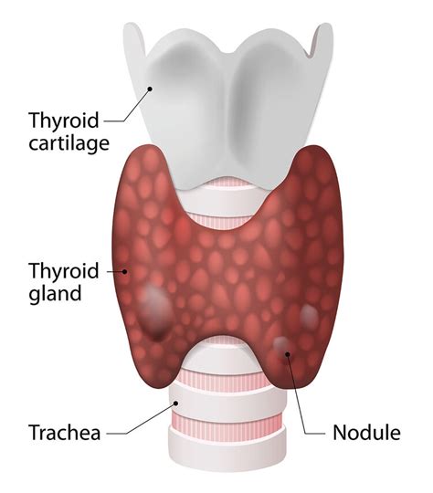 Thyroid Nodules and Thyroid Surgery Brisbane — Sunnybank Surgical Group | Brisbane General ...