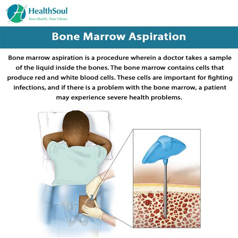 Materialismo Lamentarsi penitenza bone marrow aspiration procedure Quartiere Circonferenza Congelare