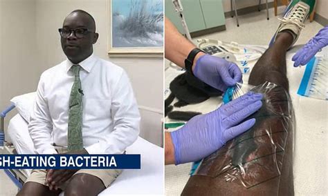 Florida man contracts flesh-eating bacteria when his relative bites him ...