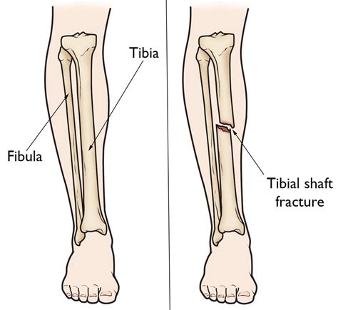 Tibia (Shinbone) Shaft Fractures - OrthoInfo - AAOS