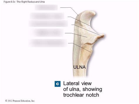 Radial Notch