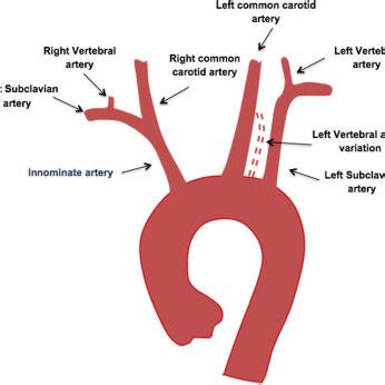 Aortic arch with the innominate artery (1), left common carotid artery... | Download Scientific ...