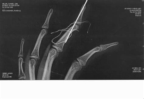 Broken Finger Post Surgery | That big thing is a pin going t… | Flickr