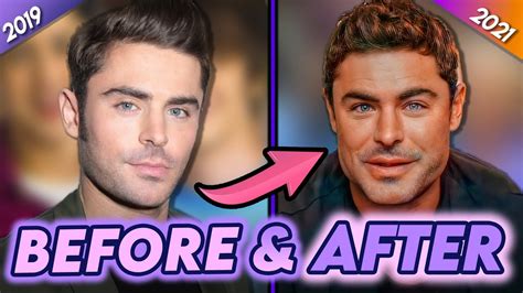 zac efron before after jaw surgery - Ignorant Steel