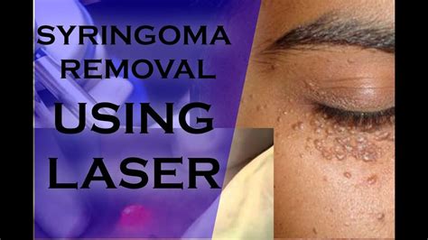 laser treatment for syringoma cost - burgard-kishaba99