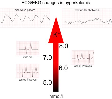 5 ECG Changes of Hyperkalemia you Need to Know – Acadoodle – Medium