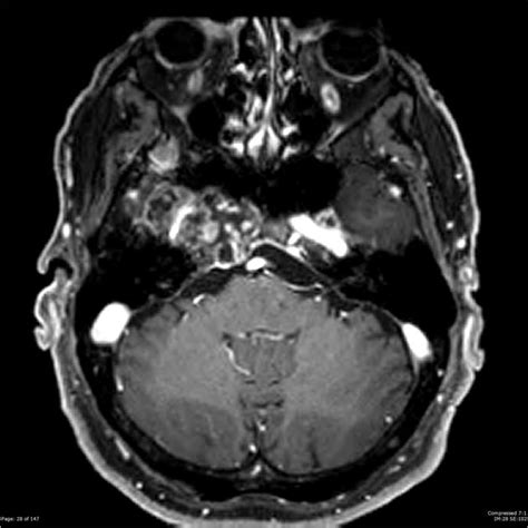 Chondrosarcoma of the skull base | pacs