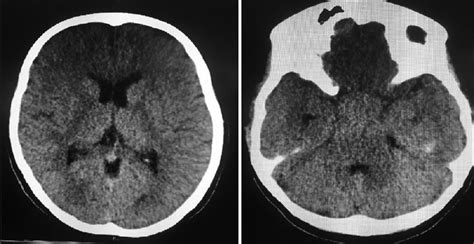 Surgical Neurology International