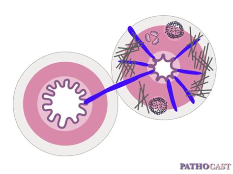 Morphology and complications of Crohn's disease - DocCheck