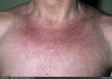 STOCK IMAGE, plaque scleroderma morphea also known as localized scleroderma on the chest c cid ...