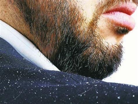 Beard Dandruff - Causes, Prevention and Treatment - URBANE MAN