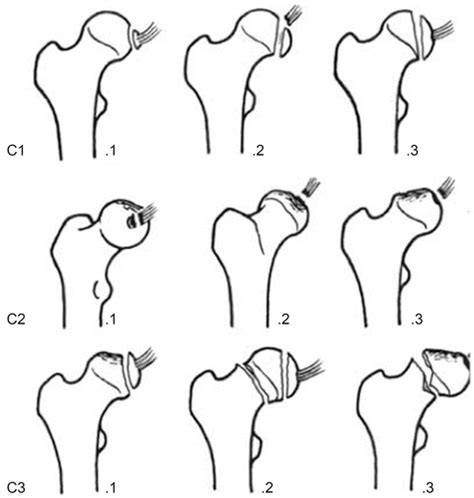 Femoral Head Fractures | Musculoskeletal Key