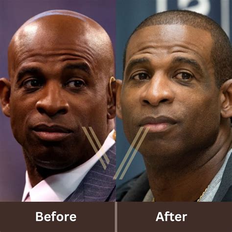 Deion Sanders' Hair Transplant: Before and After Transformation