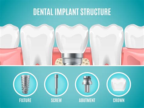 Tooth Implants: Everything You Need to Know | Hove Dental Clinic