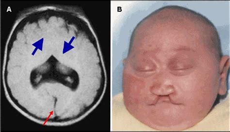 Holoprosencephaly | Treatment, Diagnosis, Sonography