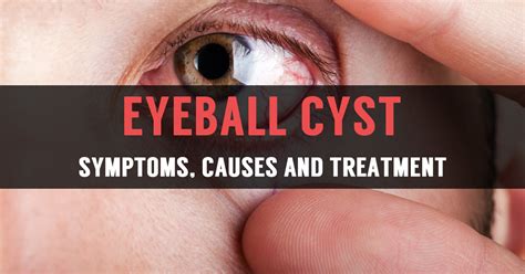 Learn Reasons for Eyeball Cyst and Its Treatment