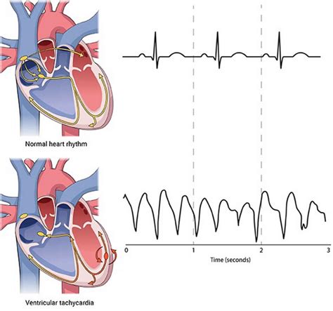 Ventricular fibrillation causes, symptoms, diagnosis, treatment & prognosis