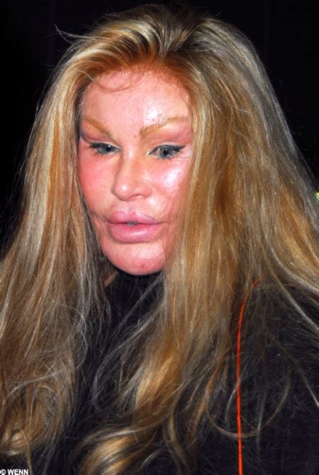 unenablu: botox gone wrong