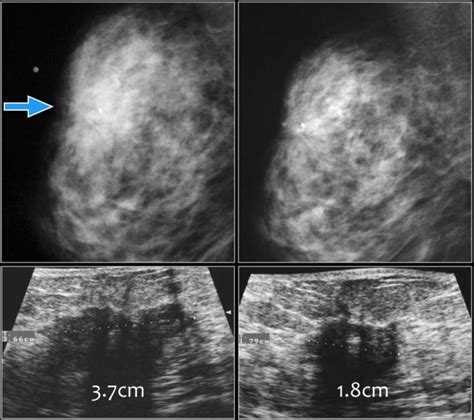 The Radiology Assistant : Bi-RADS for Mammography and Ultrasound 2013