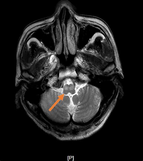 A meta-analysis of case studies and clinical characteristics of ...