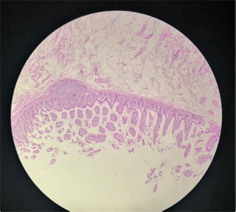 Histopathology depicts a cystic formation in the site of the cecum and ...