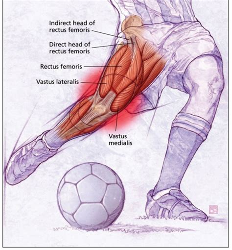 Tear of the Rectus Femoris Direct Head – Surgical Repair | HC Chang ...