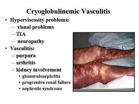 VASCULITIS Alexandra Balbir-Gurman Definition Blood vessels