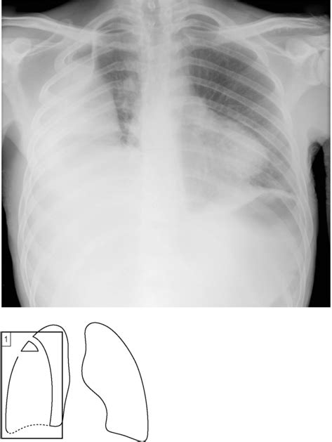 Empyema | Radiology Key