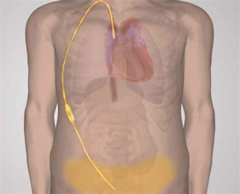 Portal Hypertension - Causes, Symptoms, and Treatment