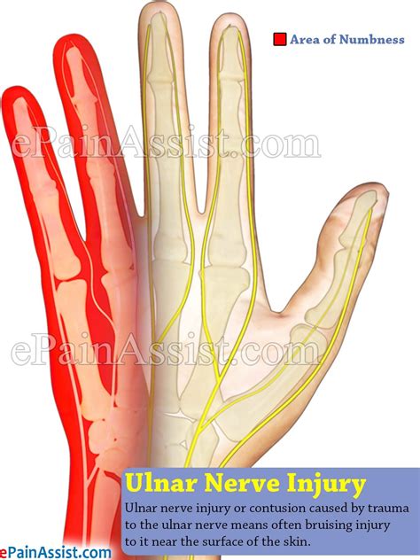 Ulnar Nerve Injury | Ulnar nerve, Ulnar nerve entrapment, Nerve entrapment