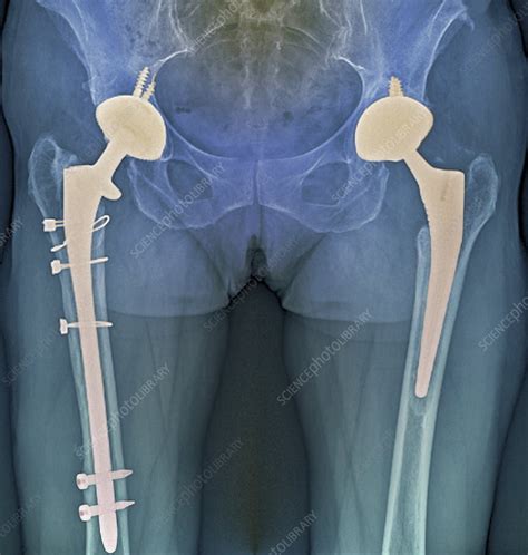 'Double hip replacement, X-ray' - Stock Image - C002/6532 - Science Photo Library