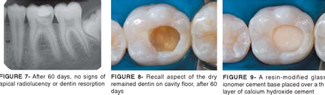 [PDF] INDIRECT PULP TREATMENT IN A PERMANENT MOLAR: CASE REPORT OF 4-YEAR FOLLOW-UP | Semantic ...