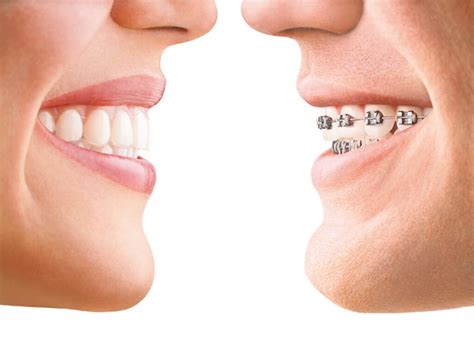 Which one is better? Invisalign vs. Braces - Smile Well Dental