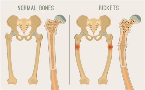 Osteomalacia: Symptoms, Causes, and Treatment – ActiveBeat – Your Daily Dose of Health Headlines