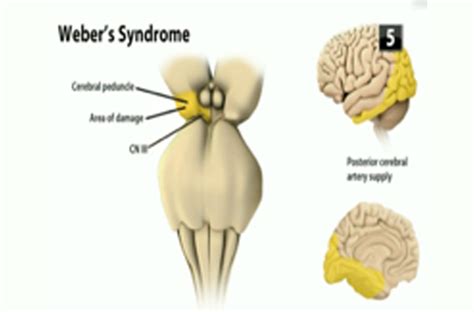 Weber Syndrome Symptoms