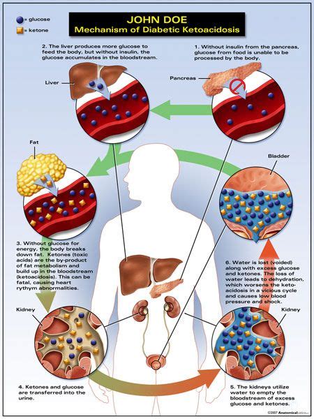 Ketosis vs. Diabetic Ketoacidosis | Diabetes treatment, Graphics and In pictures